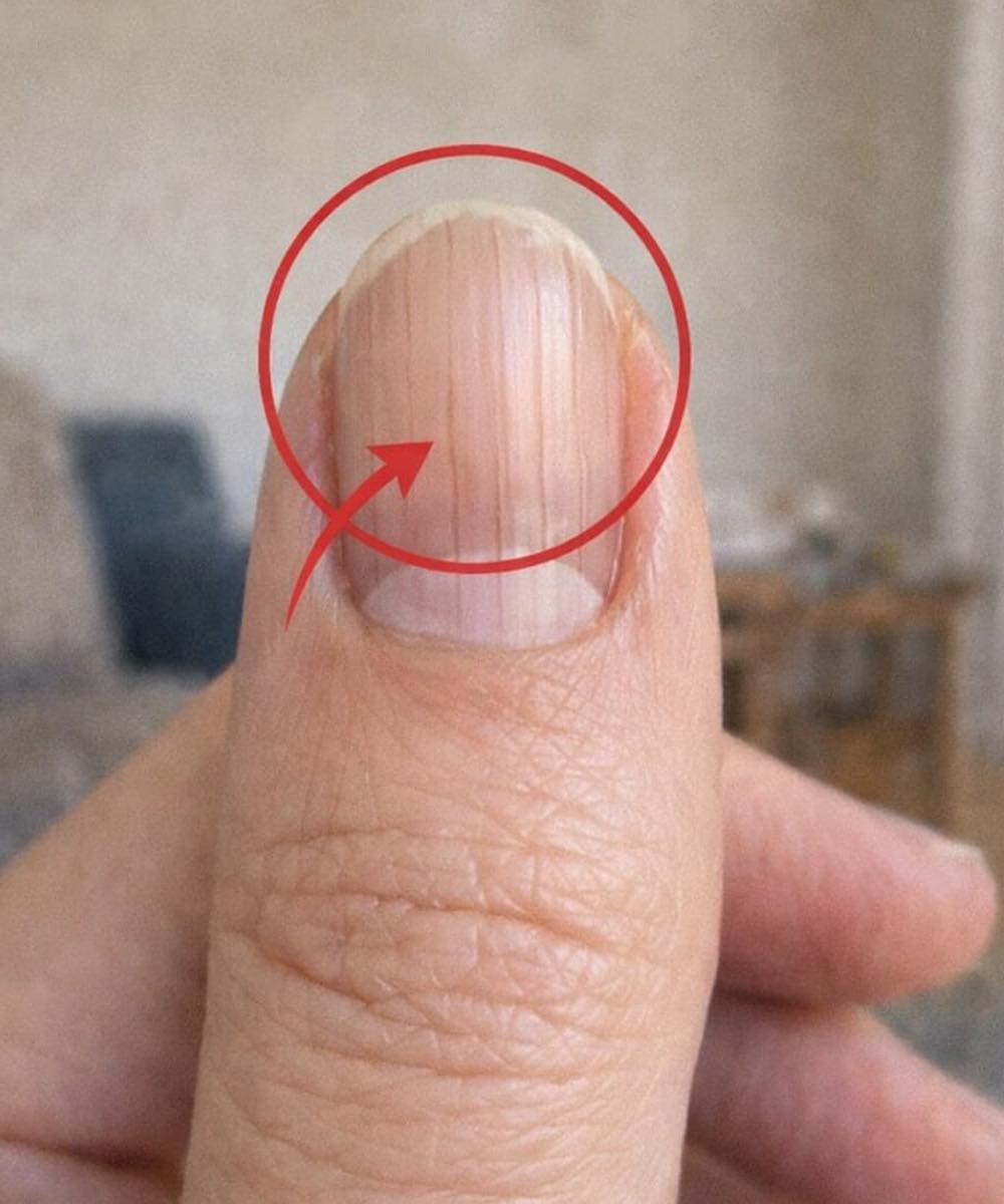 A doctor identifies a revealing clue in your fingernails that could indicate how long you might live.